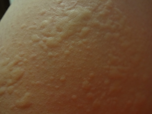 皮膚炎　ネズミ　アレルギー　蕁麻疹